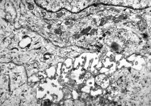 M,42y. | malignant mesothelioma - pleura M,42y. | malignant mesothelioma - pleura